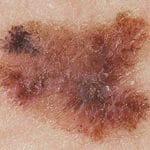 Asymmetrisk - Tegn på føflekkreft