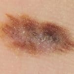 Begrensning - Tegn på føflekkreft