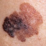 Diameter - Tegn på føflekkreft