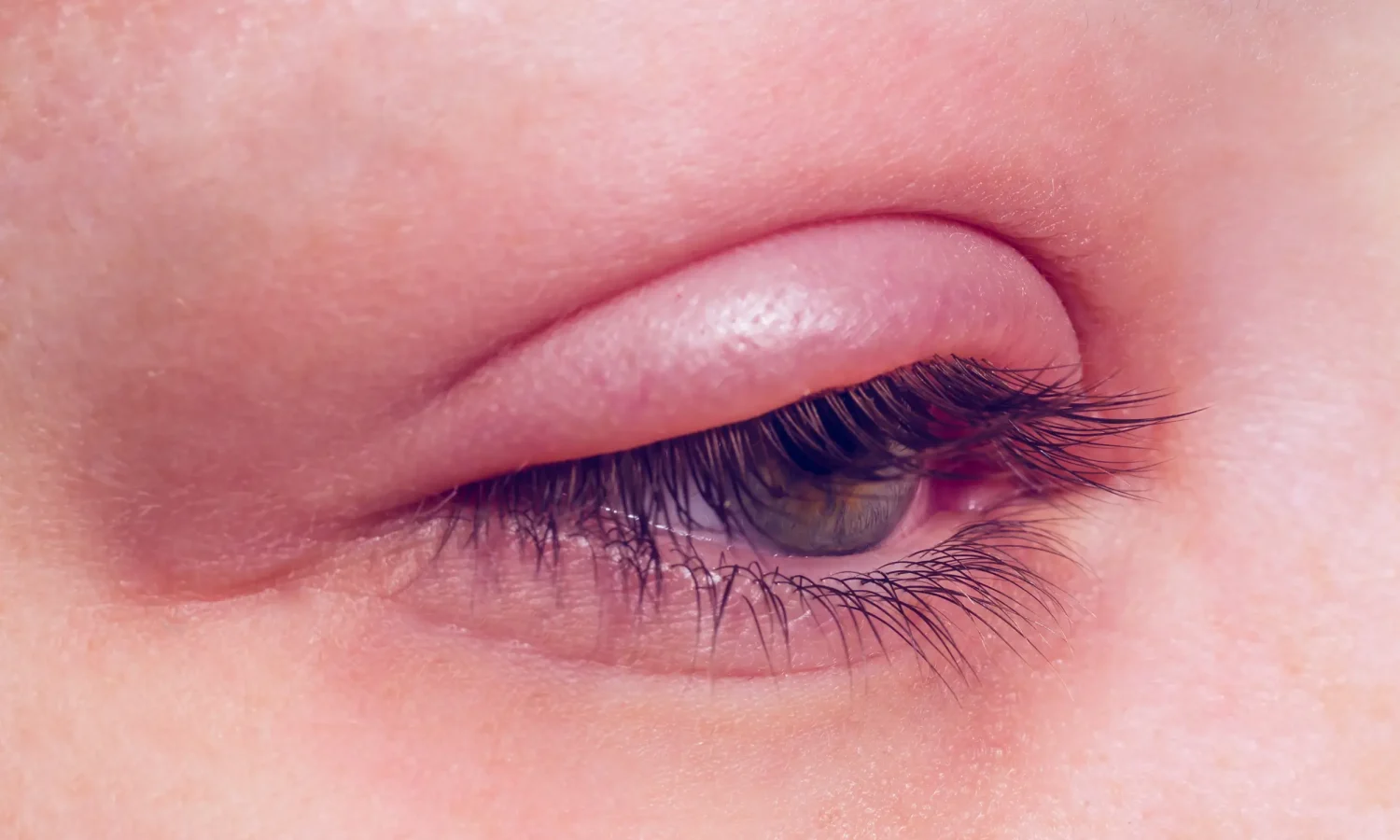 Chalazion - Sti eller kul på øyelokk