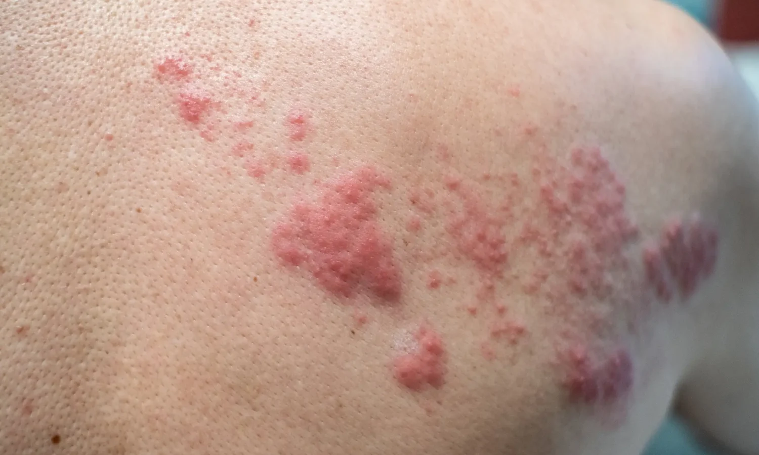 Utslett - Oppsøke lege