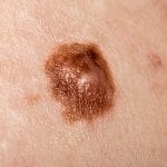 Endring - Tegn på føflekkreft