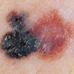 Farge - Tegn på føflekkreft